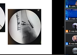 【科创骨科云沙龙精彩回顾】关于“足踝关节周围复杂骨折的处理”，听听专家怎么说！